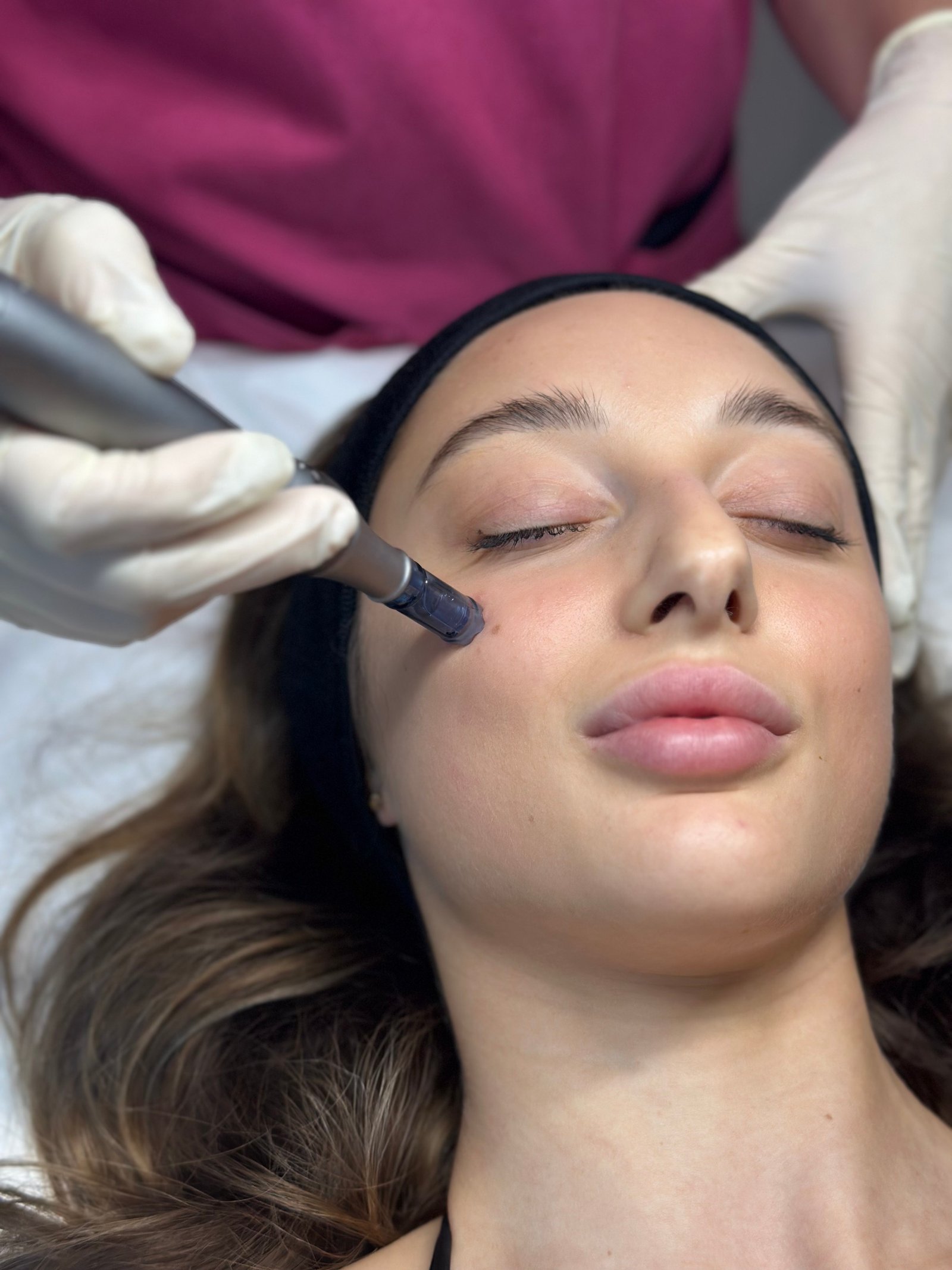 Microneedling