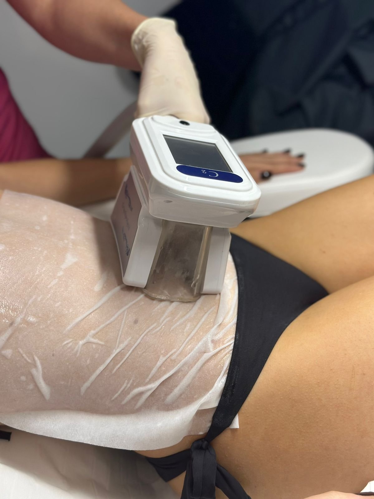 Κρυολιπόλυση